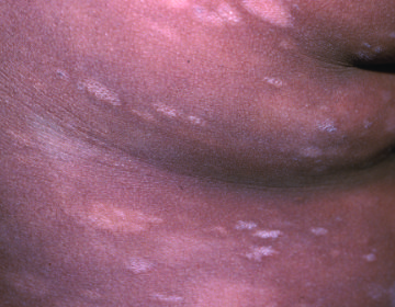 Artistic rendition of Stage IA/IB MF-CTCL as Hypopigmentation